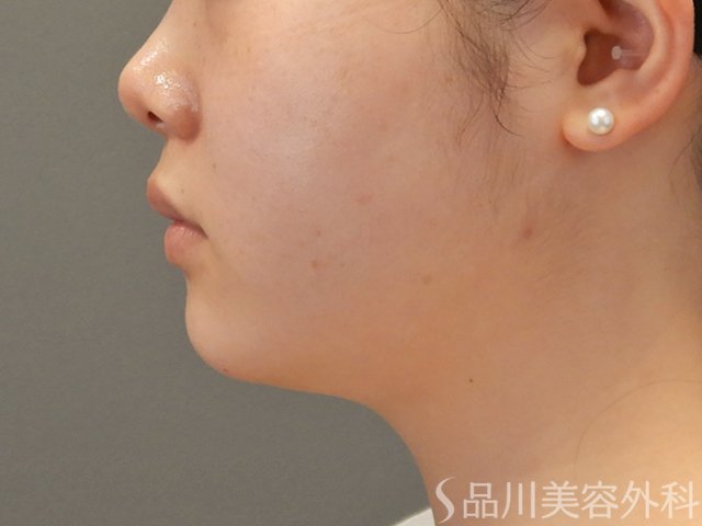 症例NO.75230のAFTER写真