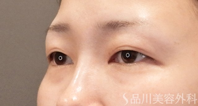 症例NO.75158のBEFORE写真