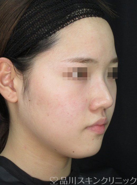 症例NO.72137のAFTER写真