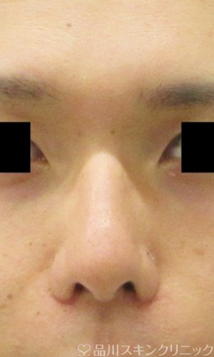 症例NO.65305のAFTER写真