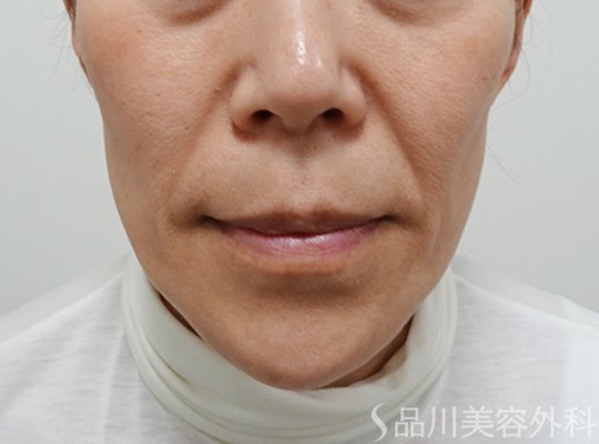症例NO.74978のBEFORE写真