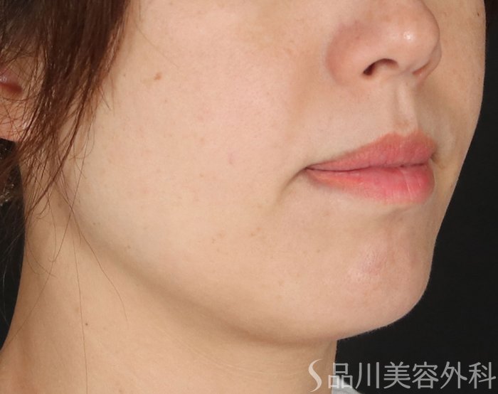 症例NO.74006のBEFORE写真