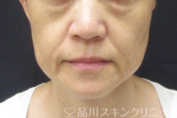 症例NO.65402のBEFORE写真