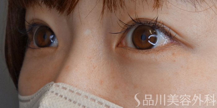 症例NO.70422のBEFORE写真