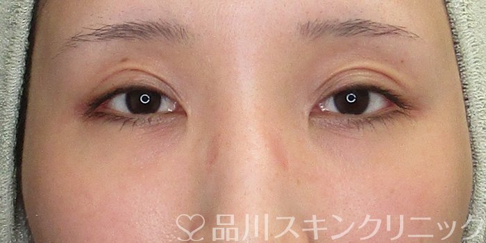 症例NO.75270のAFTER写真
