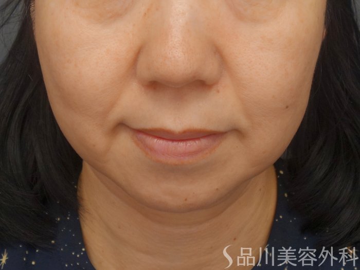 症例NO.69319のBEFORE写真