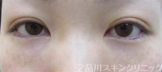 症例NO.33221のAFTER写真