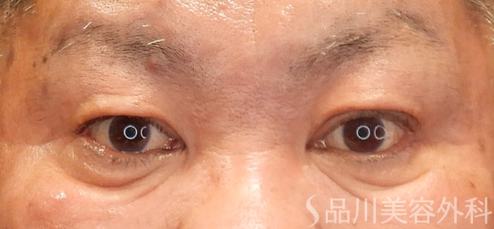 症例NO.69470のBEFORE写真