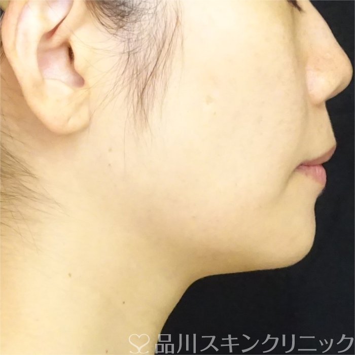症例NO.69449のBEFORE写真