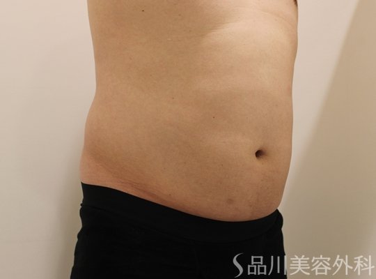 症例NO.70691のAFTER写真