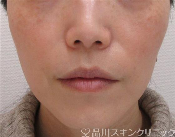 症例NO.41445のAFTER写真