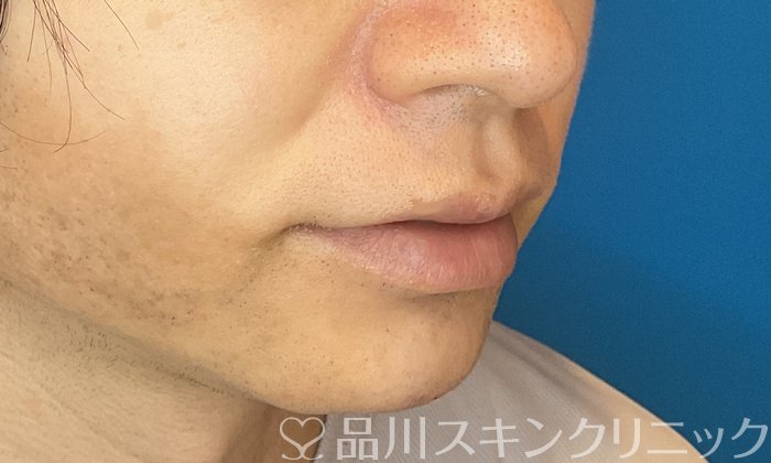 症例NO.74611のAFTER写真