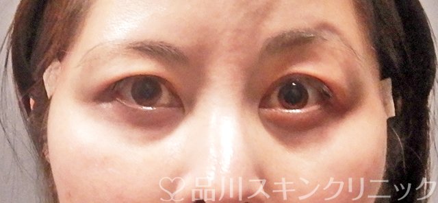 症例NO.63340のBEFORE写真