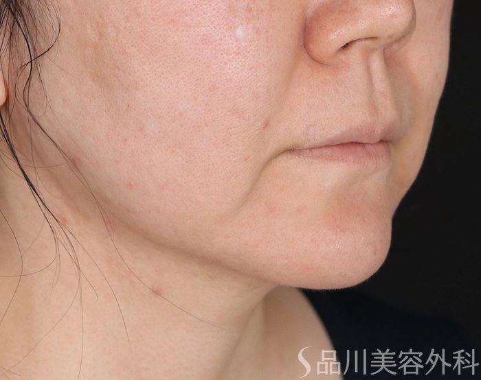 症例NO.73633のBEFORE写真
