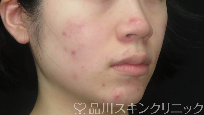 症例NO.71888のBEFORE写真