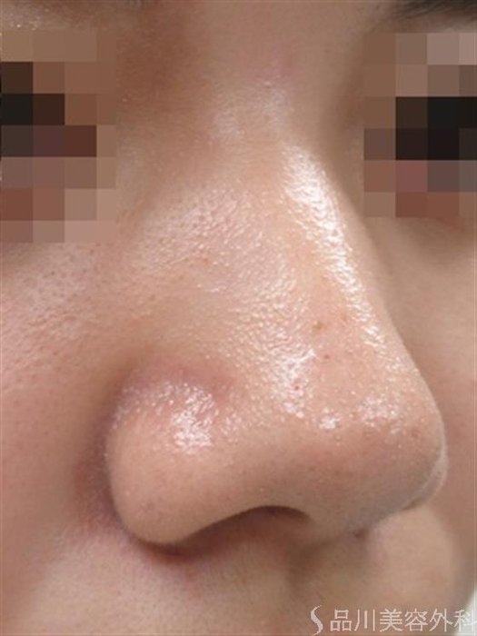 症例NO.35892のBEFORE写真