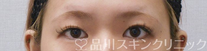 症例NO.75163のBEFORE写真