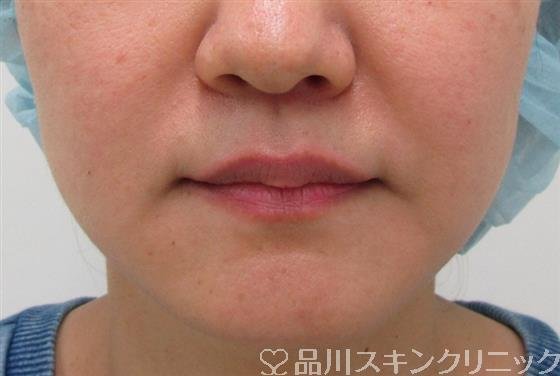 症例NO.35438のBEFORE写真