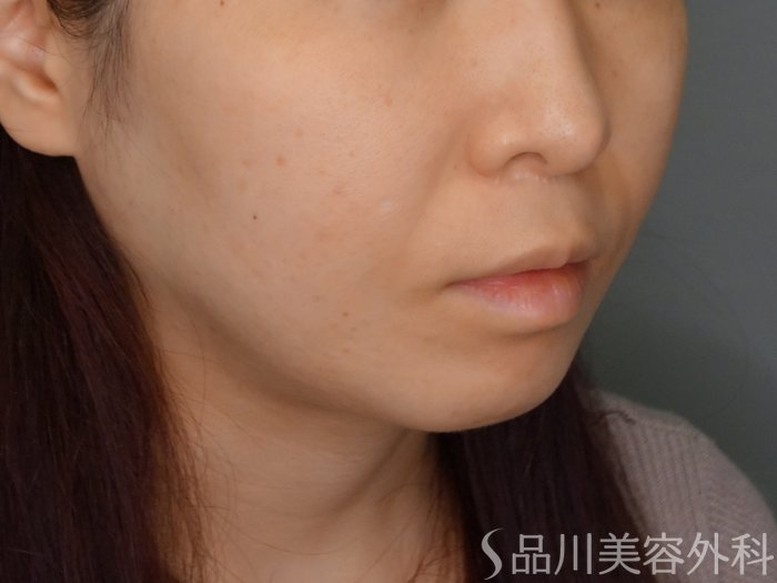 症例NO.74420のBEFORE写真