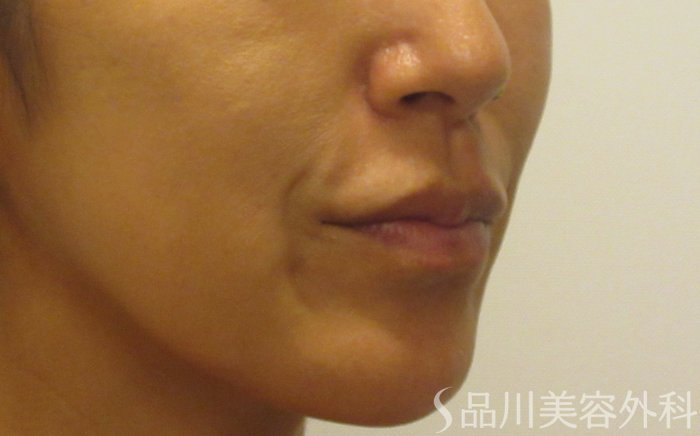 症例NO.71403のBEFORE写真