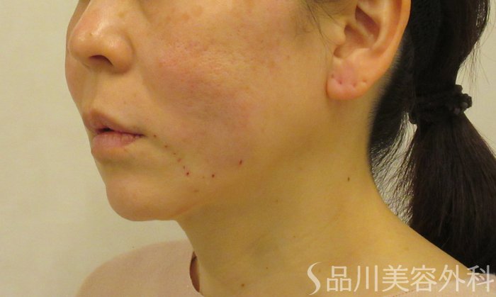 症例NO.73221のAFTER写真