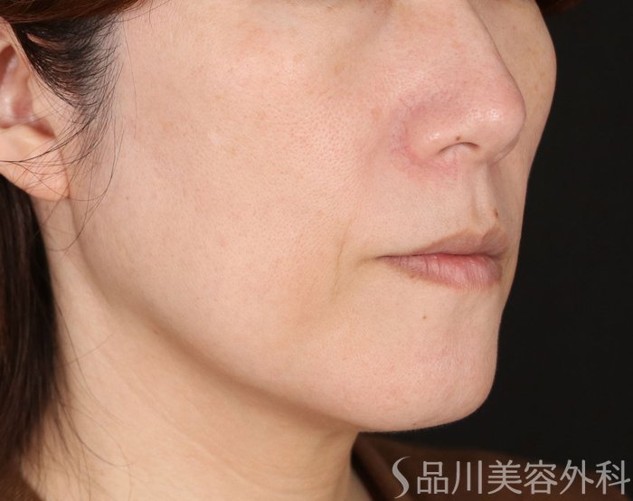 症例NO.72220のBEFORE写真