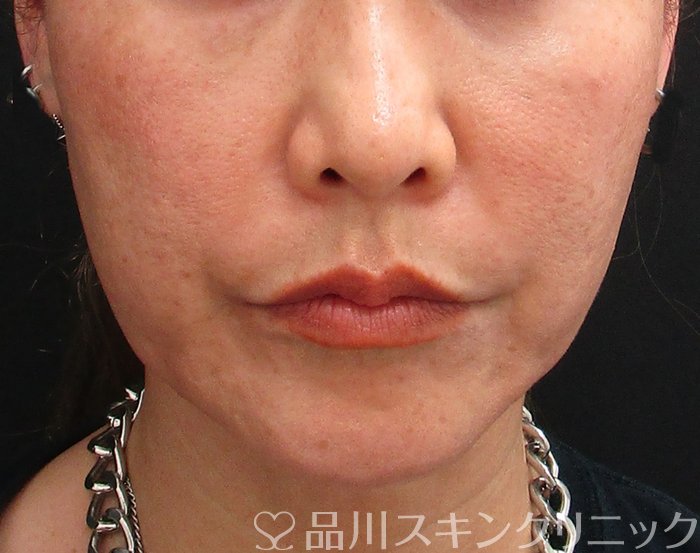 症例NO.75029のBEFORE写真