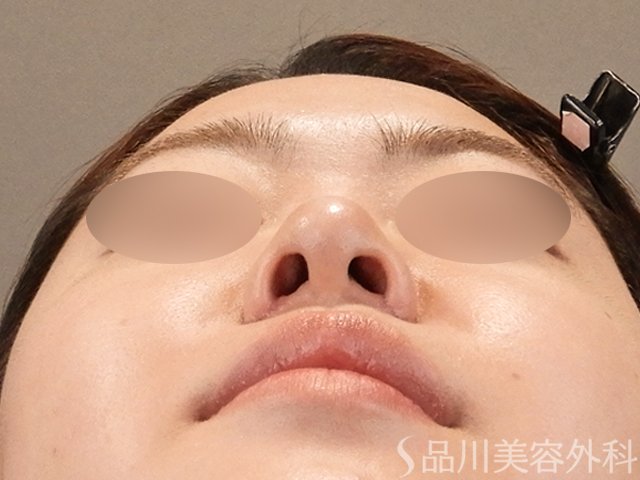 症例NO.75316のAFTER写真