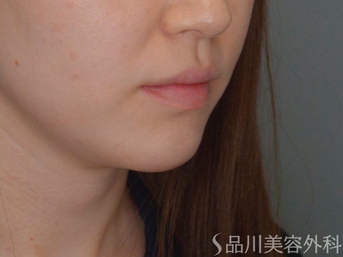 症例NO.69345のBEFORE写真