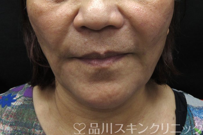 症例NO.74642のAFTER写真