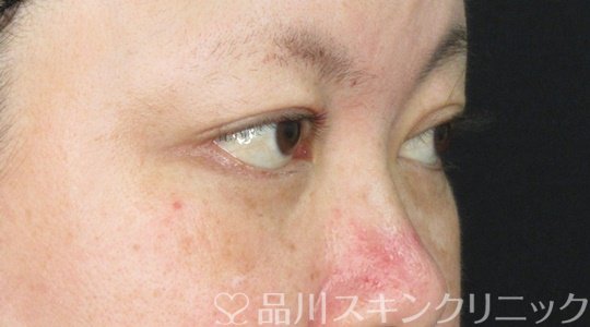 症例NO.71722のAFTER写真
