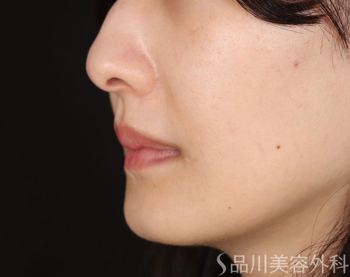 症例NO.72219のBEFORE写真