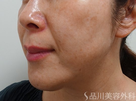 症例NO.72567のBEFORE写真