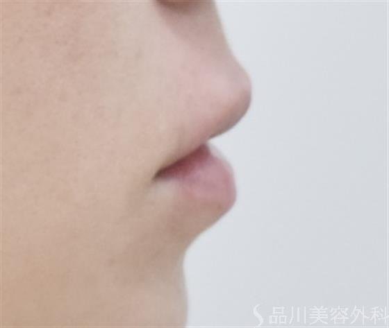 症例NO.52004のAFTER写真