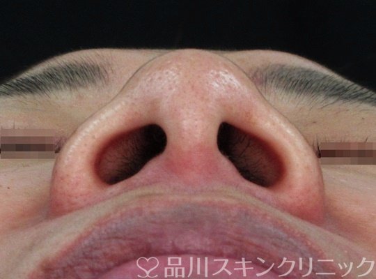 症例NO.71325のBEFORE写真