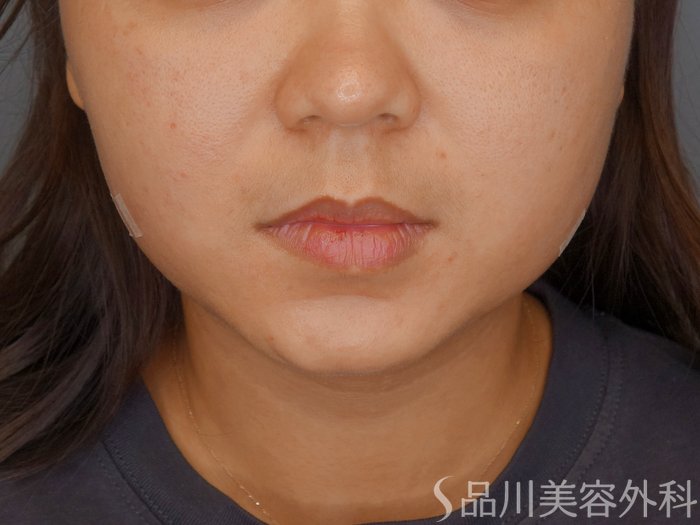 症例NO.70582のAFTER写真