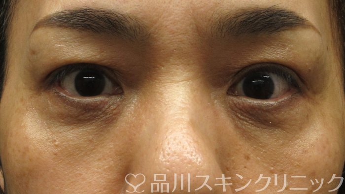 症例NO.68503のAFTER写真