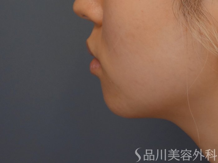 症例NO.65623のBEFORE写真