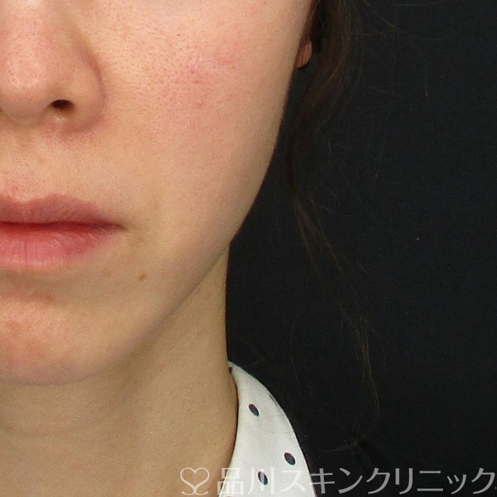 症例NO.63892のBEFORE写真