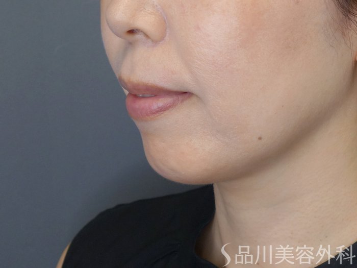 症例NO.71028のBEFORE写真