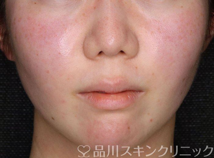 症例NO.74646のBEFORE写真