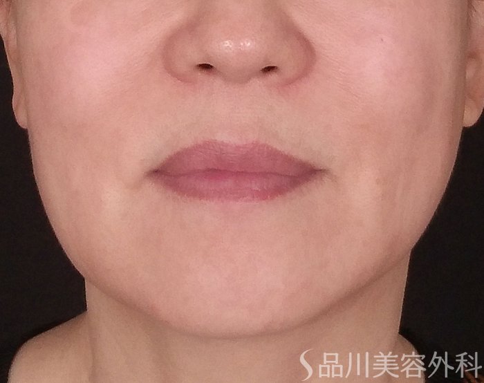 症例NO.70429のBEFORE写真
