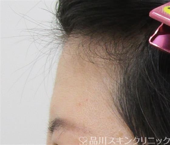 症例NO.42337のBEFORE写真