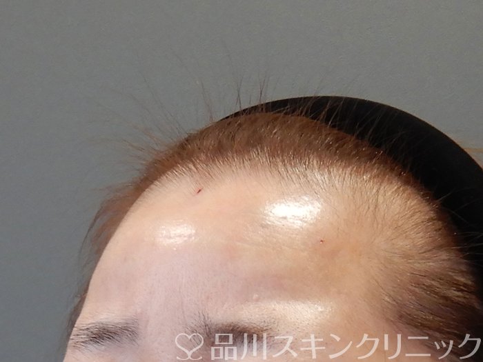 症例NO.73039のAFTER写真