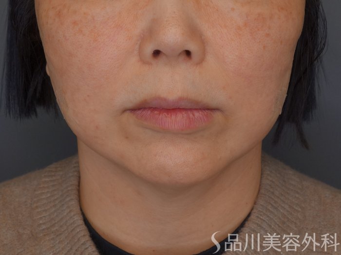 症例NO.72667のAFTER写真