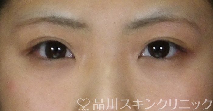 症例NO.68874のBEFORE写真