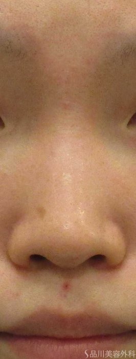 症例NO.67952のBEFORE写真