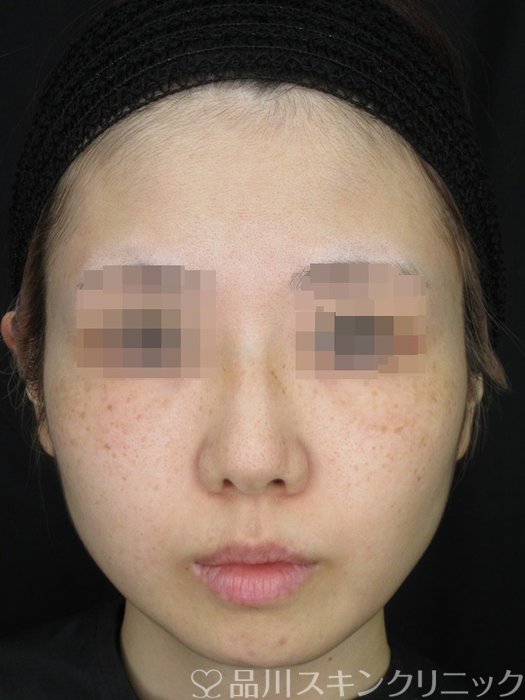 症例NO.71547のBEFORE写真