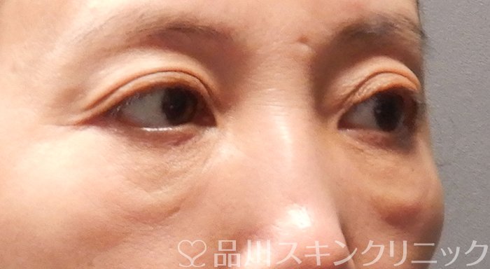症例NO.70660のBEFORE写真