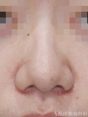 症例NO.70909のAFTER写真